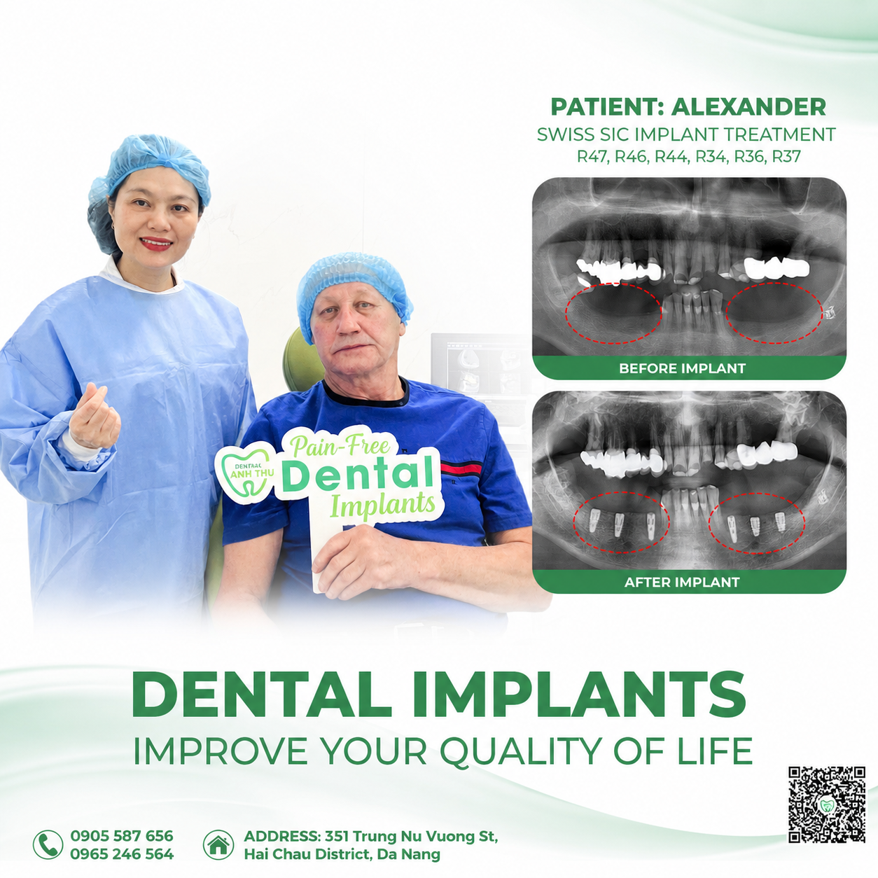 Before and after dental implants in Da Nang for international patient Alexander at Anh Thu Dental Clinic Vietnam