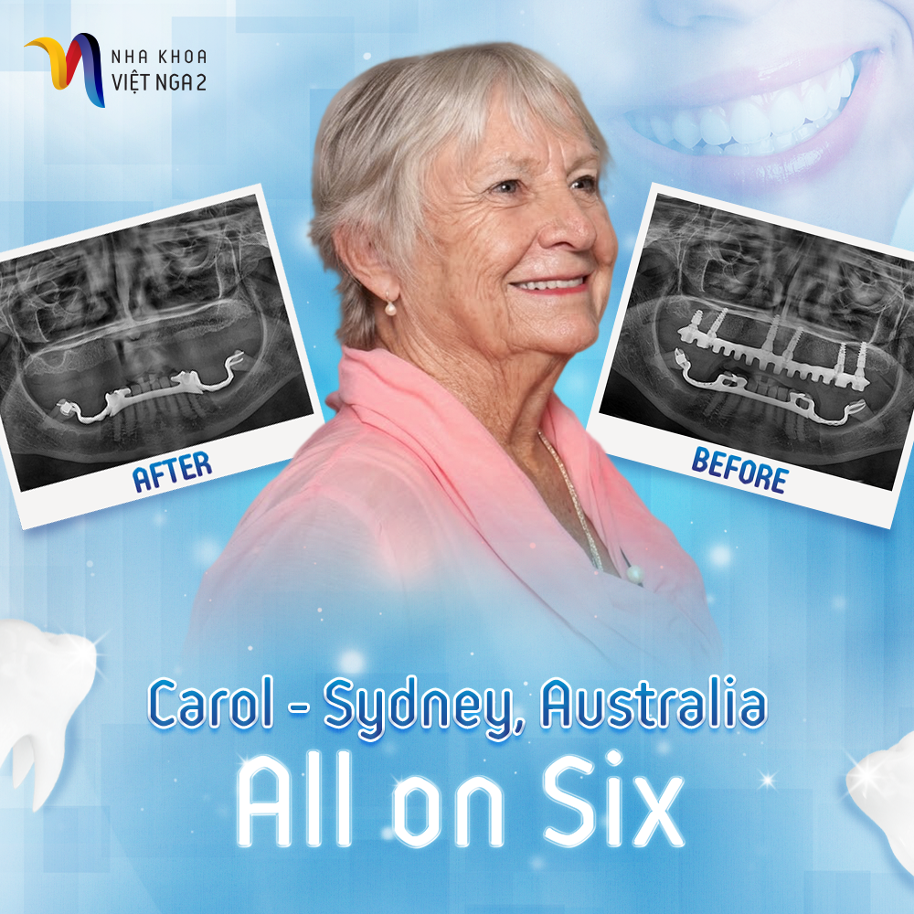 Carol after All on 6 dental implants at Viet Nga 02 Dental Clinic for patients visiting Vung Tau Vietnam